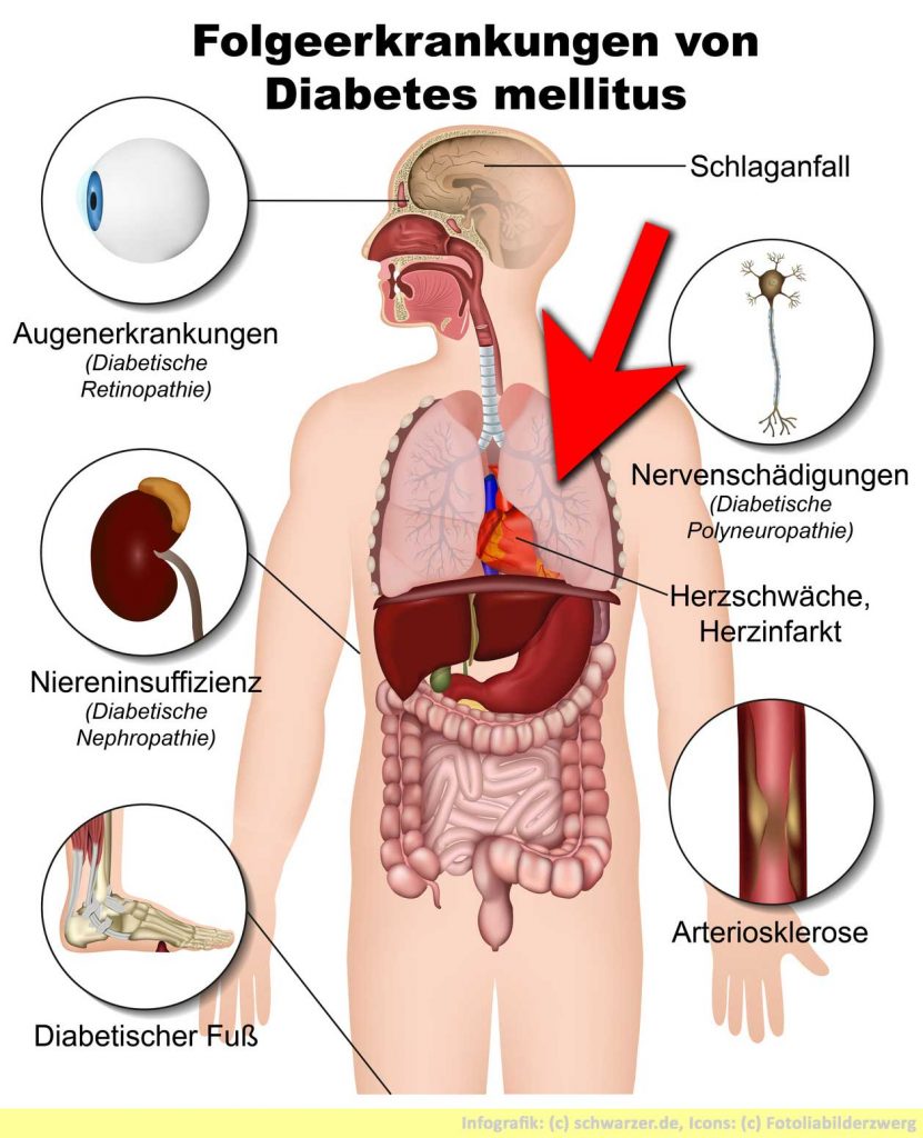 Infografik: Diabetes Mellitus Folgeerkrankungen