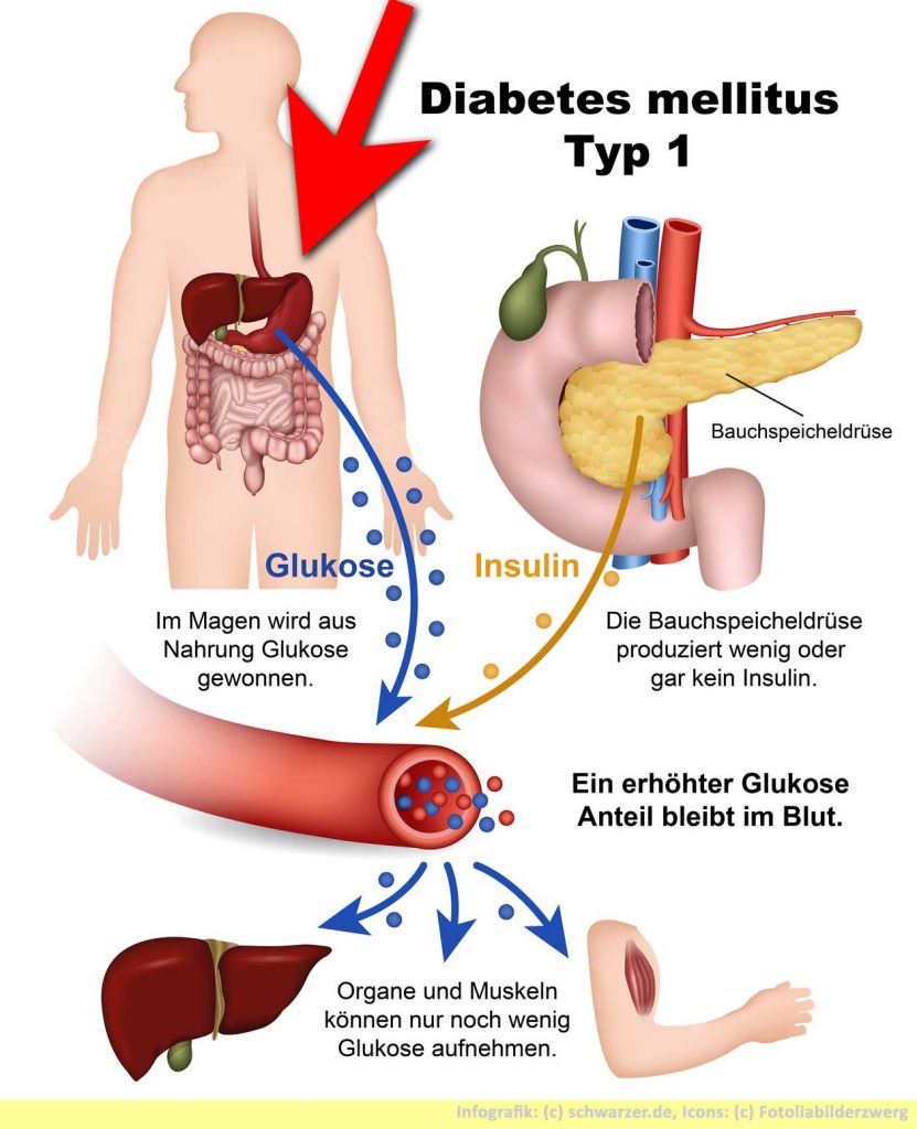 Infografik: Diabetes Mellitus Typ 1 tritt häufig schon in der Kindheit auf.