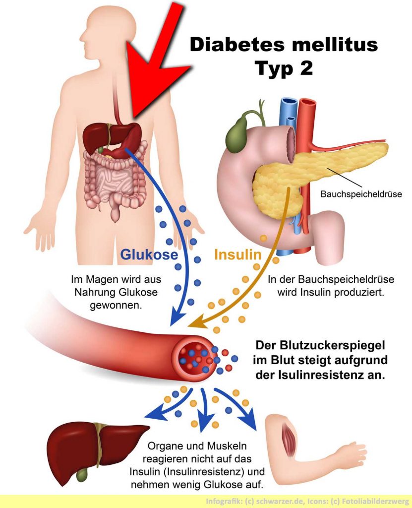 Infografik: Diabetes mellitus (Diabetes Typ 2) ist eine chronische Stoffwechselerkrankung.